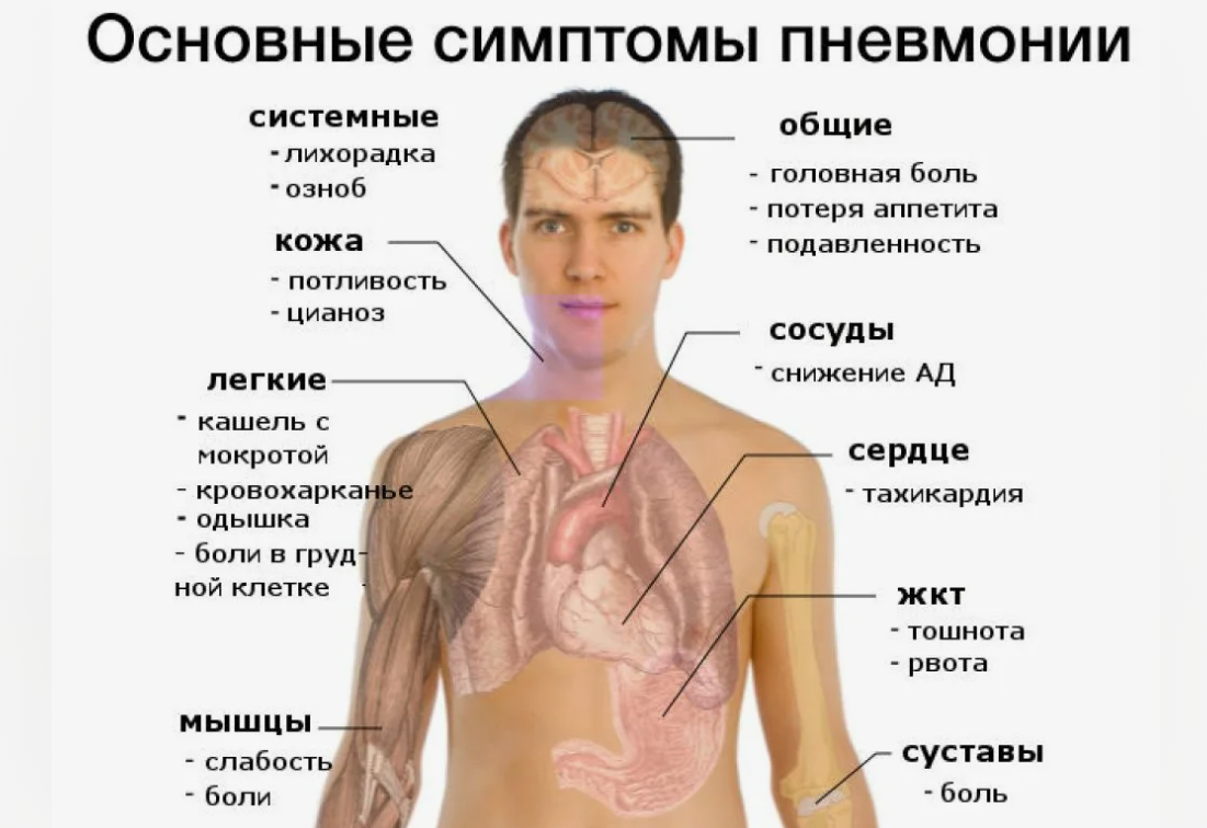 Ранние признаки пневмонии. Основные симптомы пневмонии у взрослых. Воспаление лёгких симптомы. Как отличить пневмонию от ОРВИ.