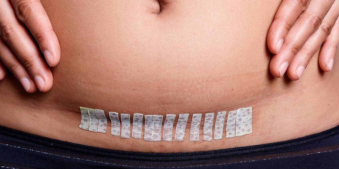 Восстановление после кесарева сечения – первые дни и последующий период: менструации, лактация и не только