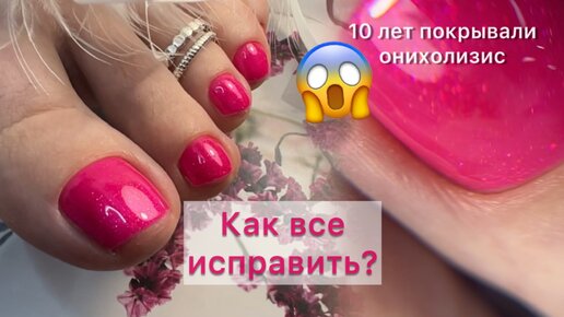 Я до сих пор в шоке! Почему все молчали 10 лет?! Онихолизис на ногтях. Как все исправить? Важное правило педикюра