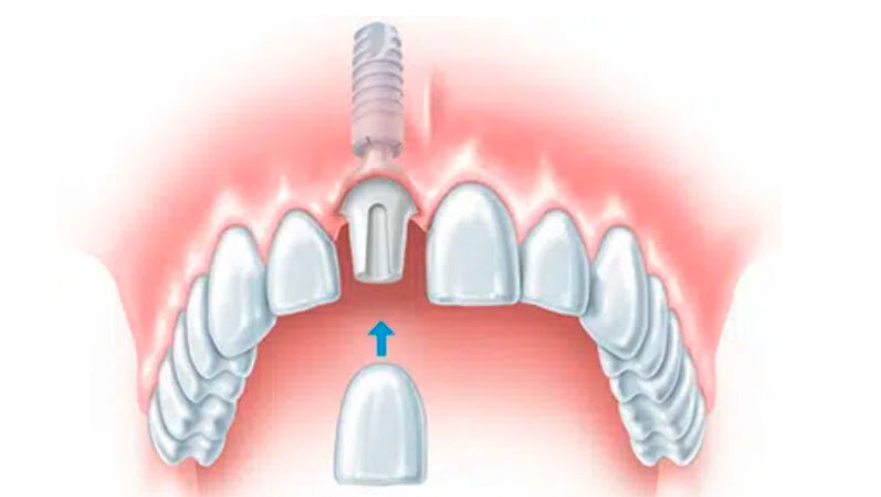 Отсутствие одного зуба