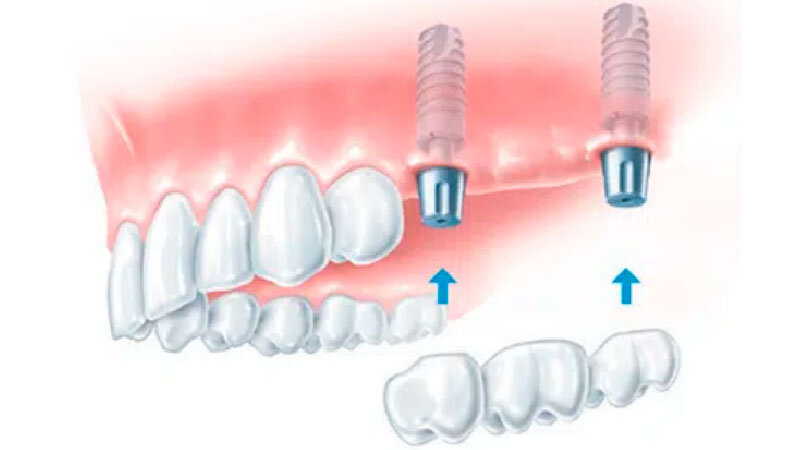 Отсутствие нескольких зубов.