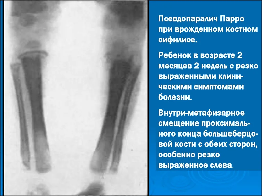 Врожденный сифилис - Педиатрия - Справочник MSD Профессиональная версия