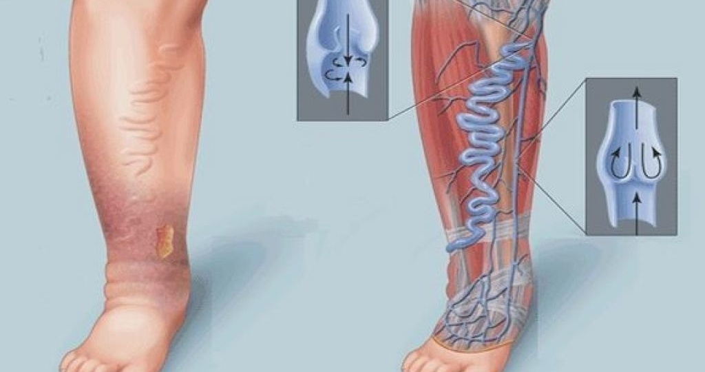 Тромбоз вен