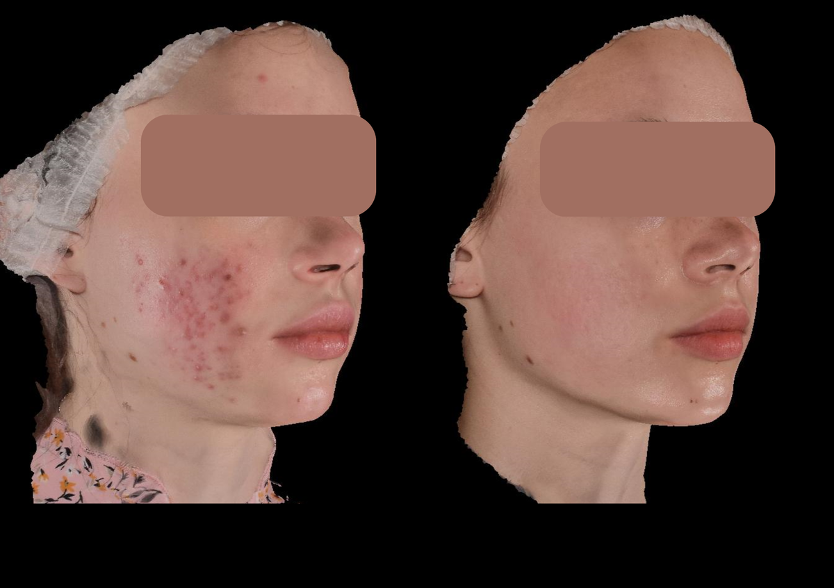 Результат через 8 месяцев лечения в Клинике Бухаровой