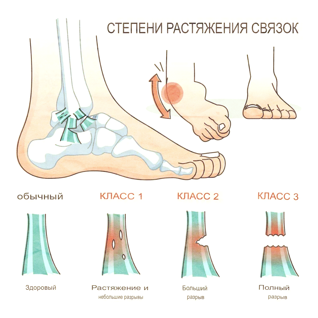 1 степень растяжения. Растяжение и разрыв связок. Степени растяжения связок. Разрыв связок голеностопа. Растяжение связок симптомы.