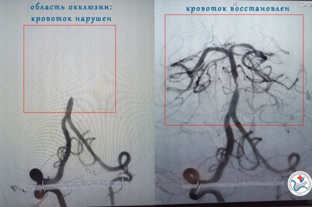    Когда кровоток в мозге нарушен, счёт идёт на часы. Фото: Пермская городская клиническая больница имени С.Н. Гринберга