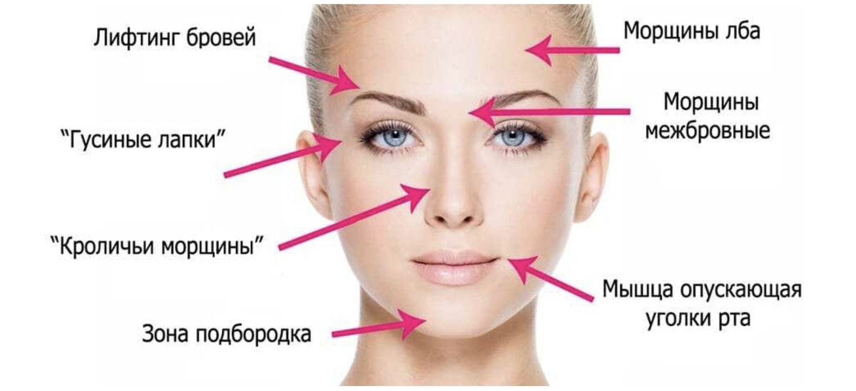 Таблица лба. Ботокс межбровье схема. Сколько единиц ботокса нужно для лба.