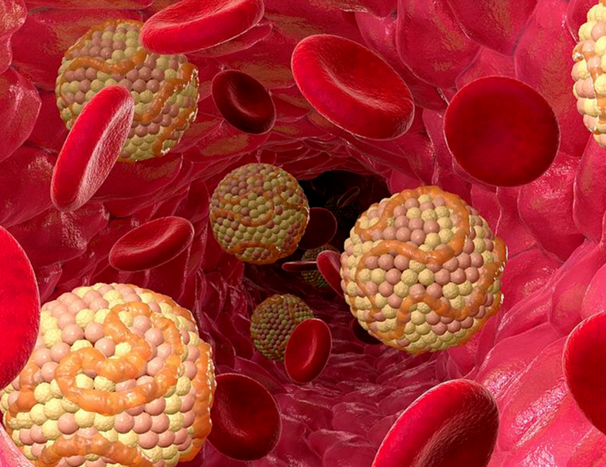 Холестериновые бляшки
