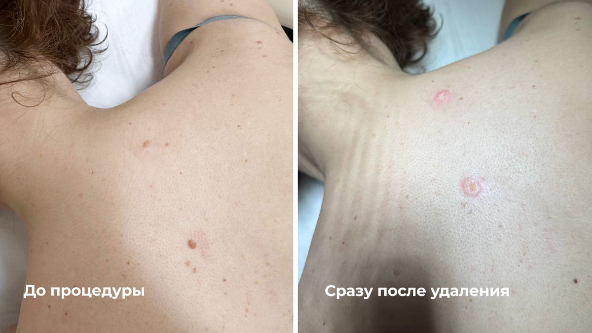 Лазерное удаление невусов на спине: до и после