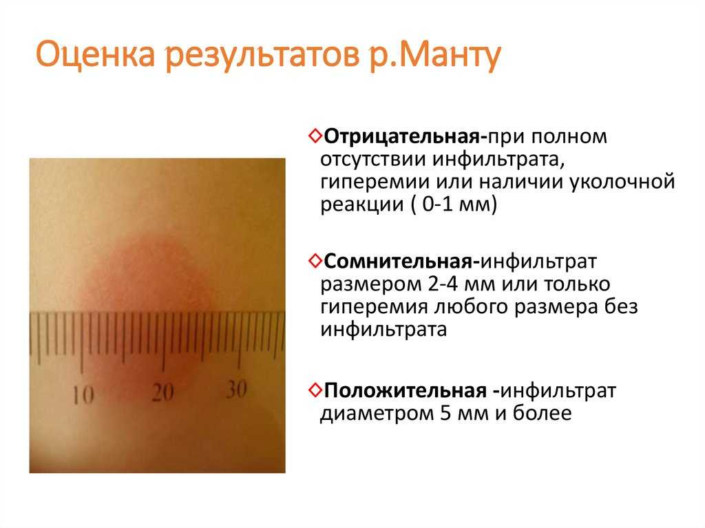 Результаты диаскинтеста как интерпретировать у взрослых фото