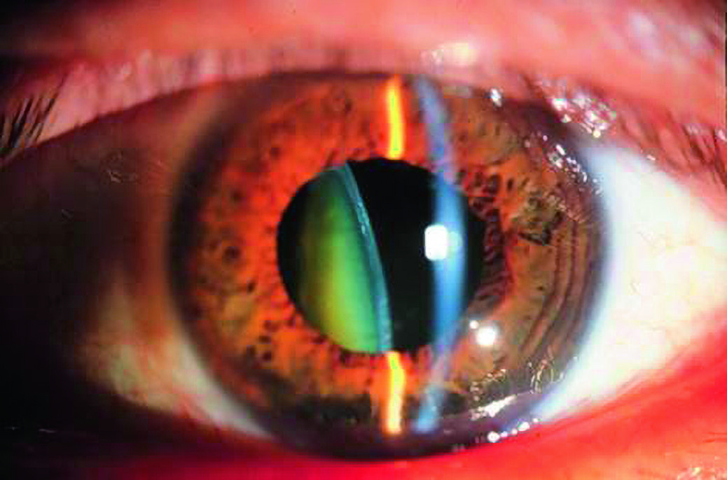 Частота выявляемости в популяции синдрома Марфана 1:25000, 
синдрома Маркезани 1:50000