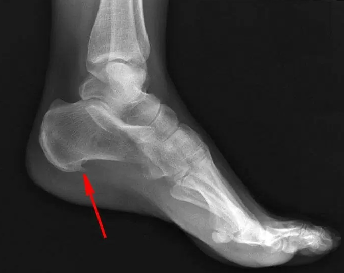 Как избавиться от пяточной шпоры