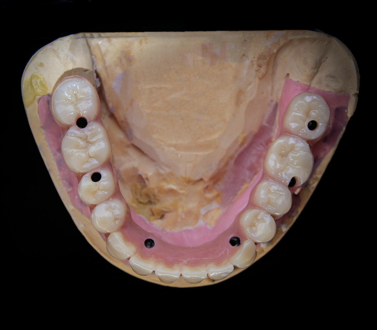 Несъемный протез акрил-титановый на рабочей модели, один из видов протезирования на имплантатах, в котором используются гарнитурные зубы, в данном случае фирмы Tribos.