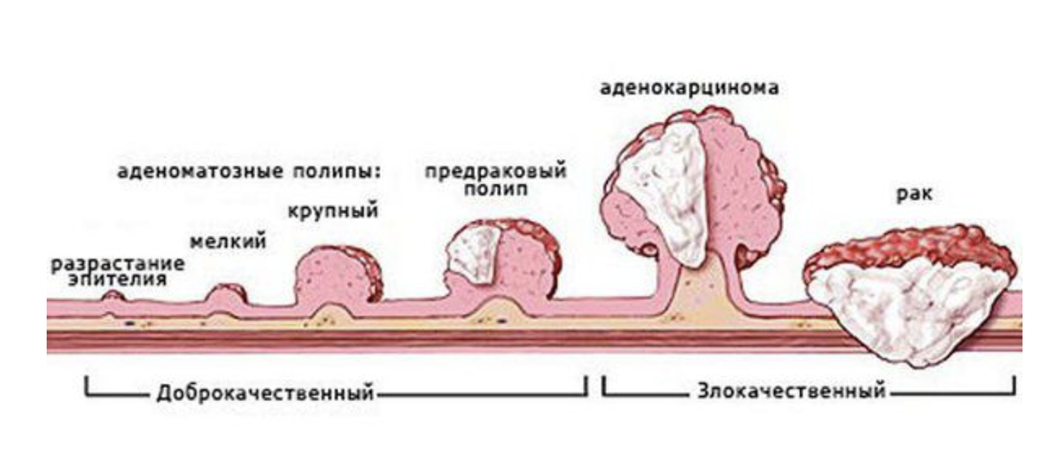 Классификация полипов желудка