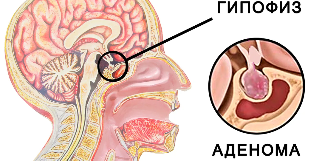 Опухоль с горошину – проблемы крайне тяжелые: что такое аденома гипофиза и откуда она берется