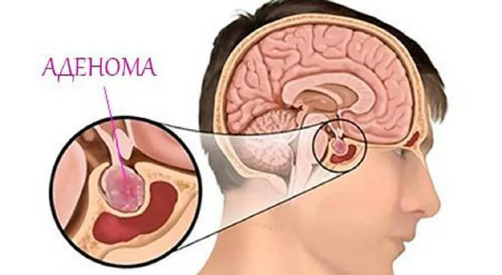 Аденома гипофиза что это такое у женщин. Соматотропная аденома гипофиза. Эндоселлярная аденома гипофиза. Операция аденомы гипофиза через нос. Эндоселлярная аденома гипофиза головного мозга.