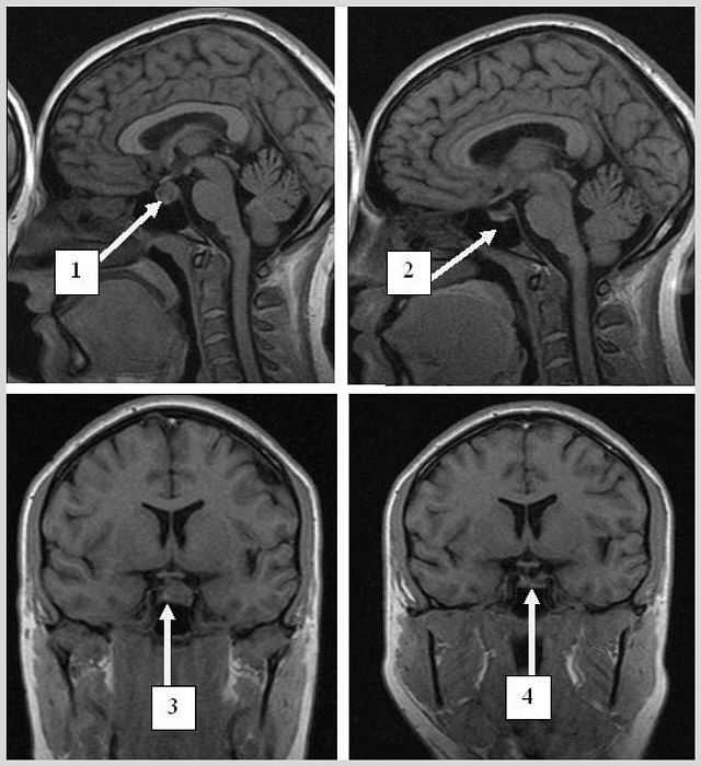Диагноз гипофиза. Пролактинома гипофиза мрт. Микроаденома гипофиза головного мозга что это такое. Опухоль гипофиза на мрт. Микроадемное гипофоза.