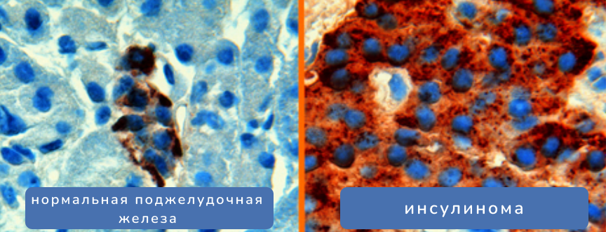 Коричневый - подкрашенный инсулин. Слева - нормальная поджелудочная железа, справа - поджелудочная железа, пораженная инсулиномой.
