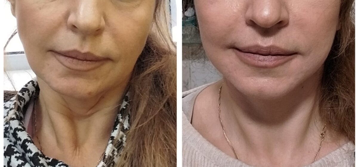 Шея и носогубка  До и После операции