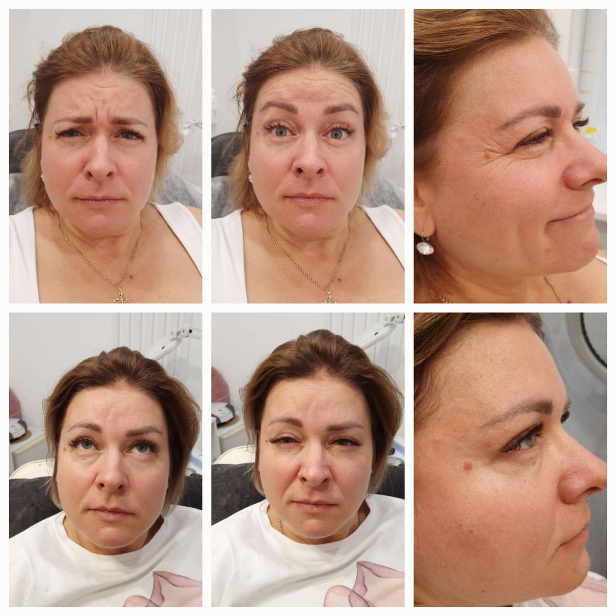 ! Тогда ботокс для лица – это то, что вам нужно !