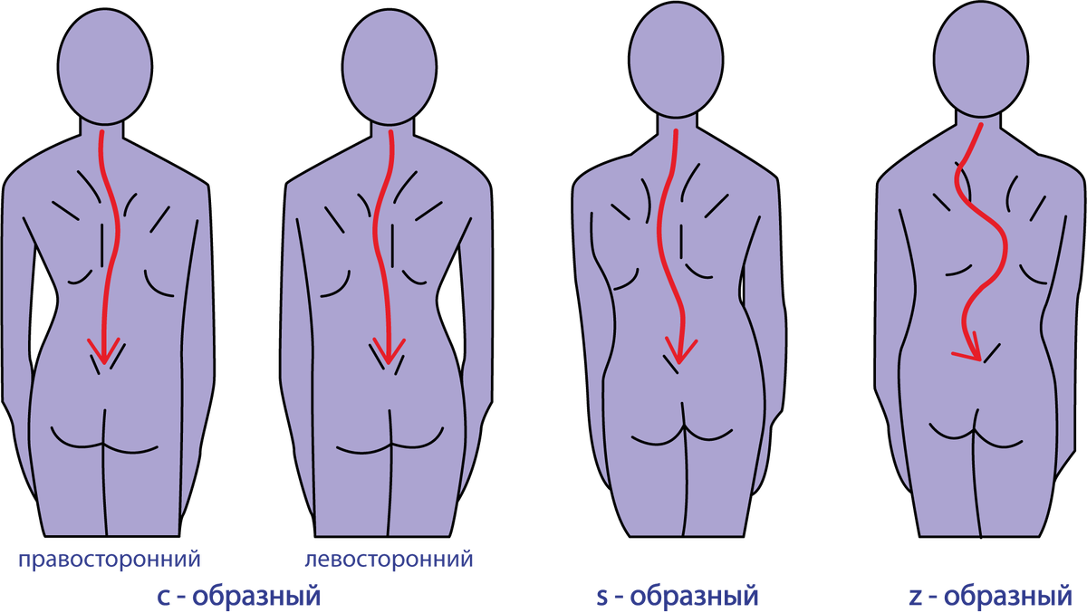 С образный сколиоз позвоночника 1 степени. Правосторонний сколиоз. Правосторонний и левосторонний сколиоз. С-образный сколиоз 1 степени. Левосторонний сколиоз 1 степени.