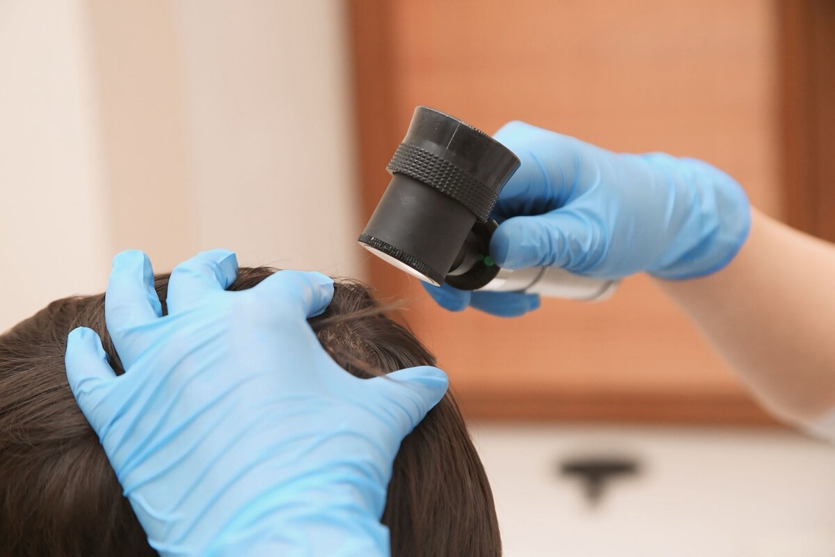 Выпадение волос: причины и лечение