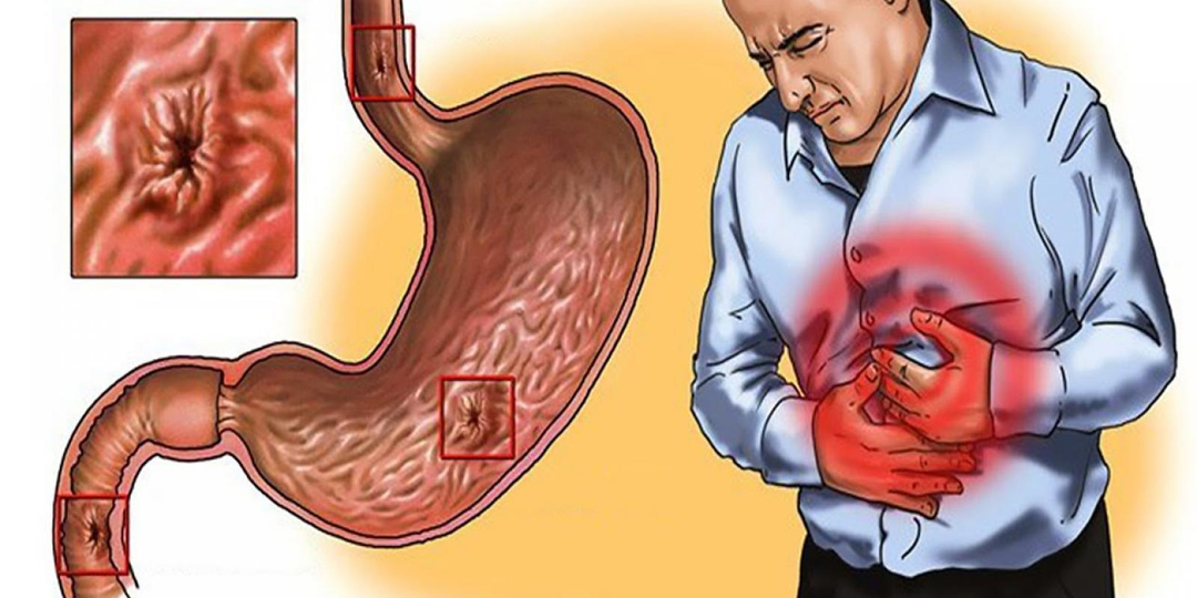 Что такое Helicobacter pylori: почему они выживают в желудке и откуда гастрит с язвой?