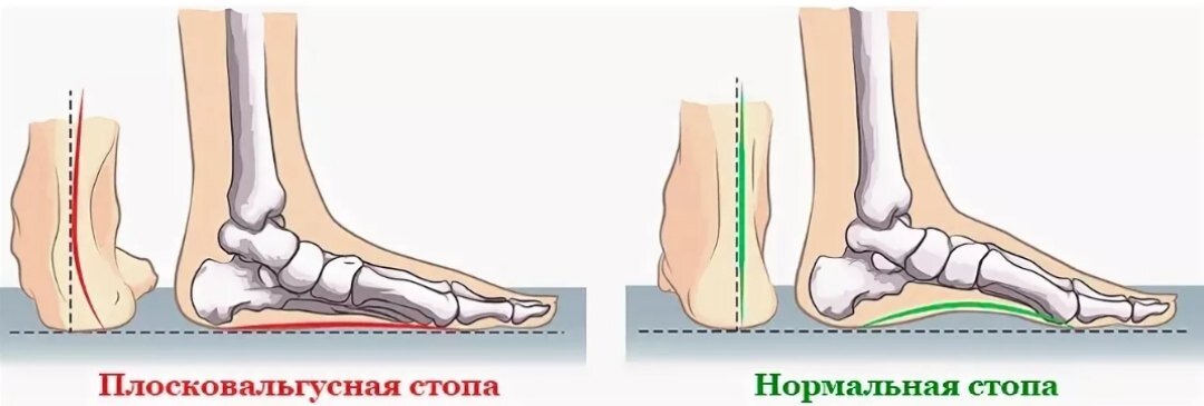 Вальгусная деформация стопы причины и лечение