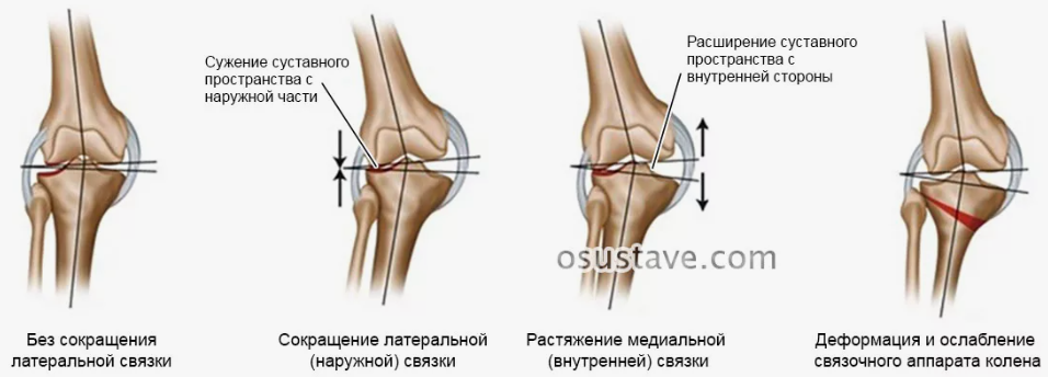 Вальгусная деформация, не классифицированная в других …