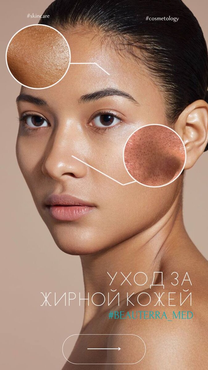 Как правильно ухаживать за жирной кожей? Разбираем с косметологом BEAUTERRA