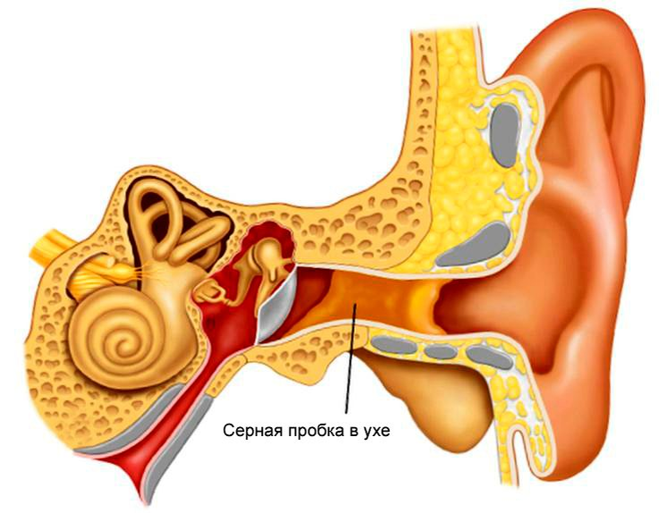 Как убрать серную пробку в ухе?