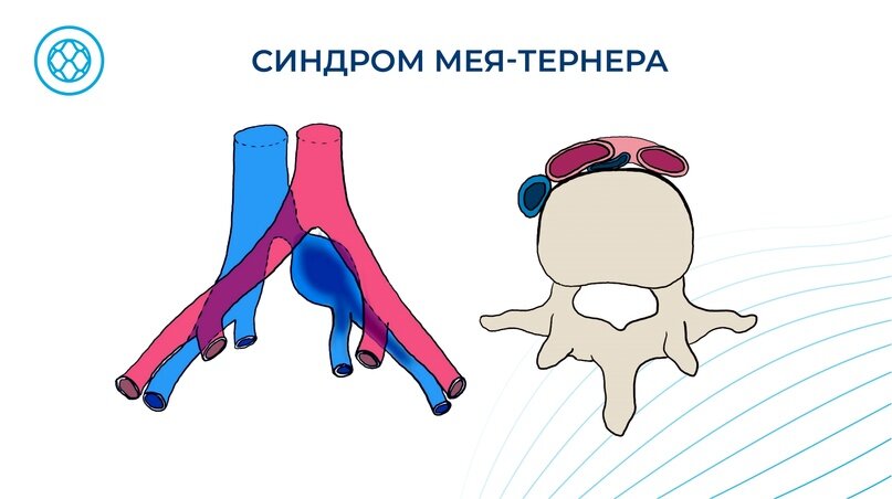 Синдром Мея-Тернера