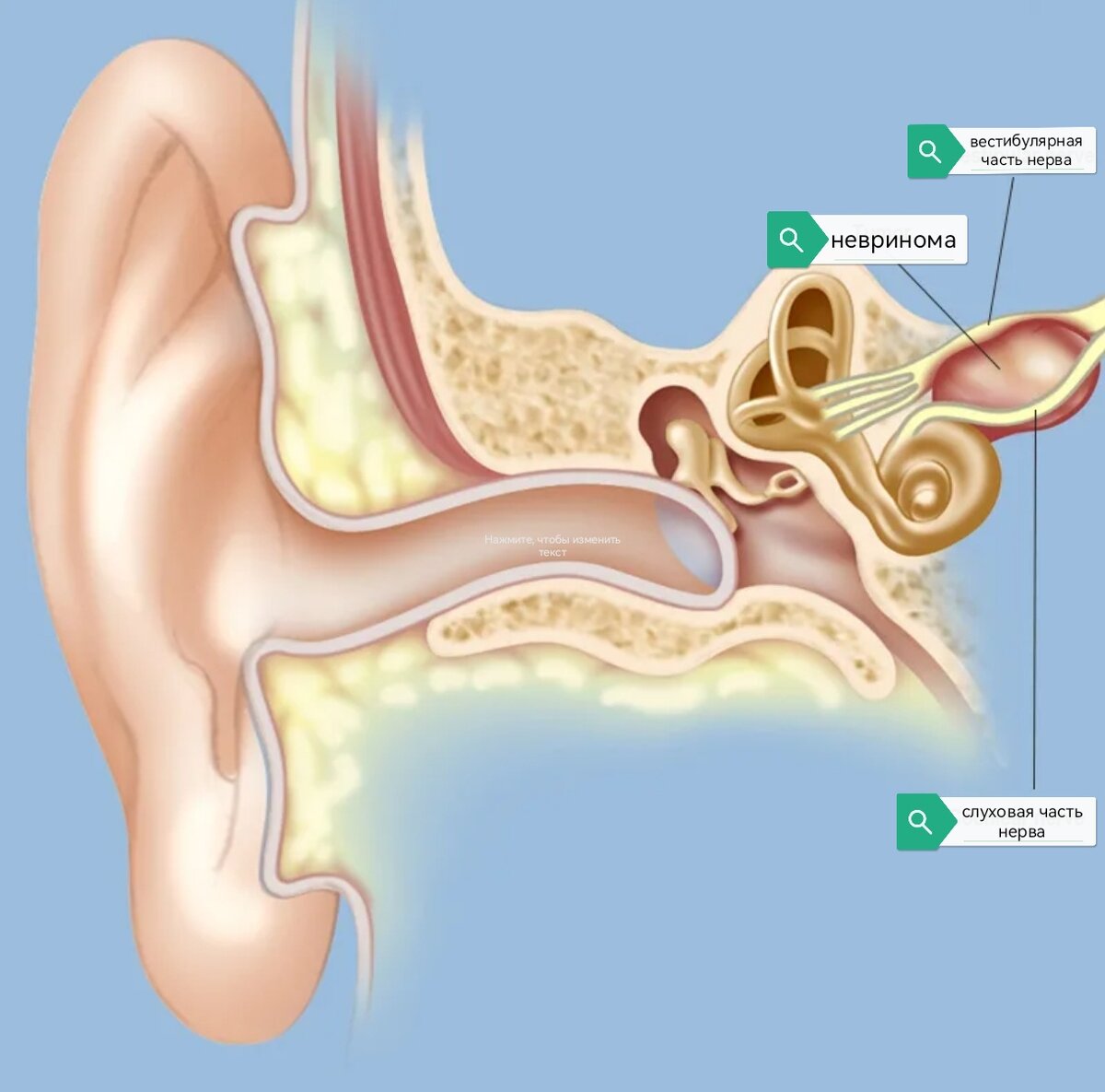 Опухоль сдавливает слуховую и вестибулярную часть нерва, что обусловливает превалирование той или другой симптоматики.