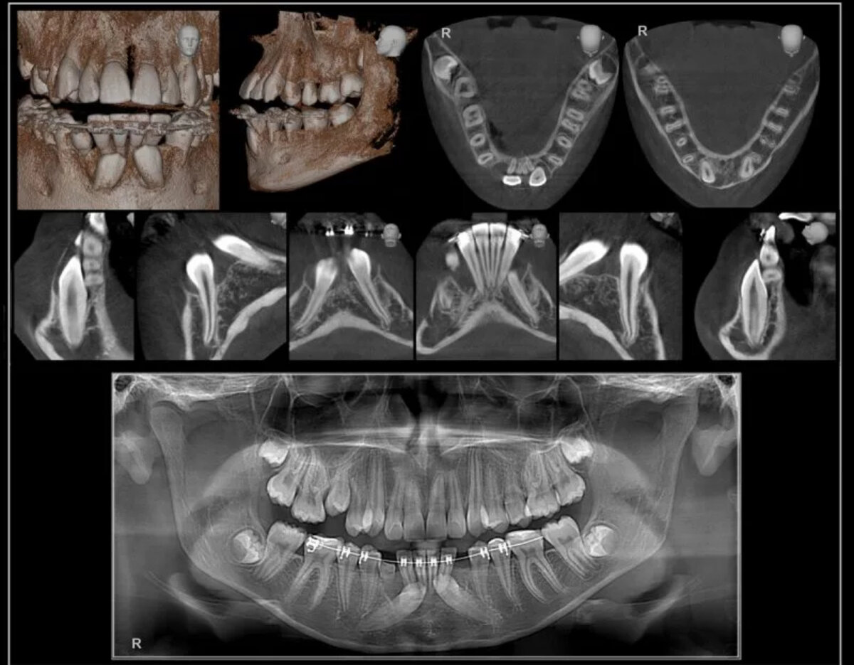 Компьютерная томография зубов в Королеве. | Эликсклиник стоматология г. Королёв | Дзен