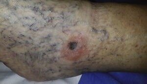 Клиническая картина. Возвышающееся над уровнем кожи, асимметричное образование темно-сине-коричневого цвета с плохо очерченными границами диаметром 1 см; по периферии очага поражения экзематизация с десквамацией на фоне отека и варикозного расширения вен. Первоисточник - Bollea-Garlatti LA, Molinari LM, Galimberti GN, Galimberti RL. Melanoma With Meyerson's Phenomenon: Clinical and Dermoscopic Features. Actas Dermosifiliogr. 2016 Apr;107(3):255-7. English, Spanish. 
Melanoma With Meyerson's Phenomenon: Clinical and Dermoscopic Features - PubMed (nih.gov)