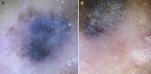 Дерматоскопия. A. бело-голубая вуаль и неравномерно распределенные бесструктурные коричнево-черные участки. B. Гломерулярные и точечные сосуды и мелкие беловатые чешуйки по периферии. Первоисточник - Bollea-Garlatti LA, Molinari LM, Galimberti GN, Galimberti RL. Melanoma With Meyerson's Phenomenon: Clinical and Dermoscopic Features. Actas Dermosifiliogr. 2016 Apr;107(3):255-7. English, Spanish. 
Melanoma With Meyerson's Phenomenon: Clinical and Dermoscopic Features - PubMed (nih.gov)