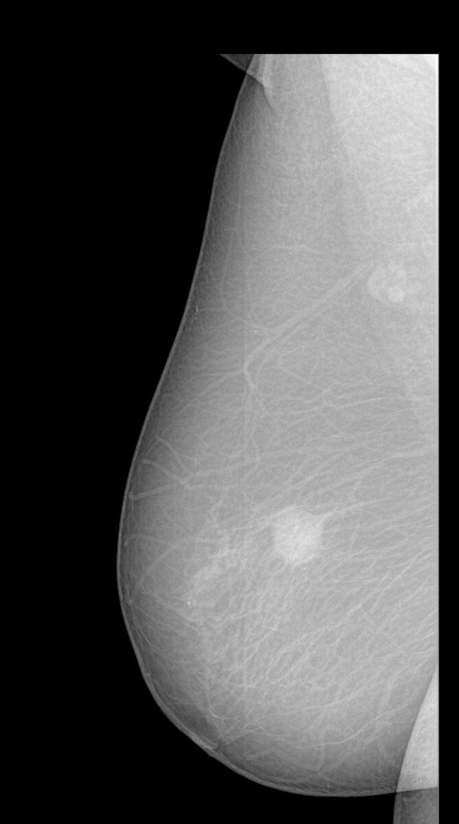 Пациентка 64 года. При маммографии, справа на границе наружных квадрантов тень опухоли 23×20 мм. Контуры чёткие и относительно ровные, что не характерно для большинства типов РМЖ.