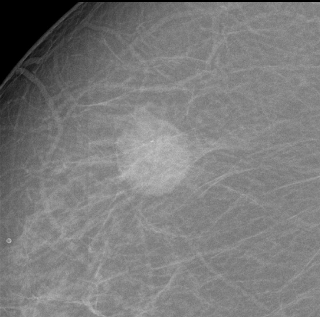 Пациентка 64 года. При маммографии, справа на границе наружных квадрантов тень опухоли 23×20 мм. Контуры чёткие и относительно ровные, что не характерно для большинства типов РМЖ.-2
