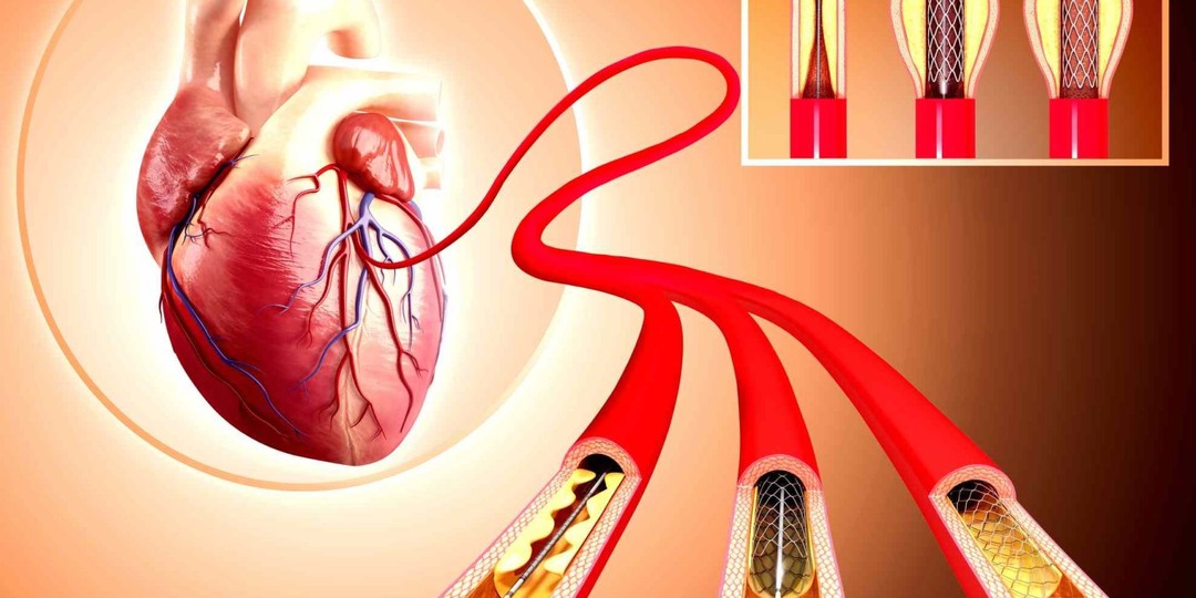 Сколько стентов можно поставить в сердце человека?