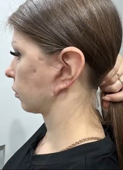 девушка через полгода после операции