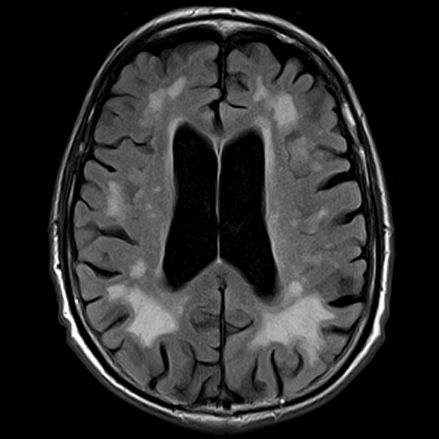 Видите эти белые очаговые изменения вокруг черных желудочков? Это и есть лейкоареоз, но тут очень выраженный. Fazekas 3.