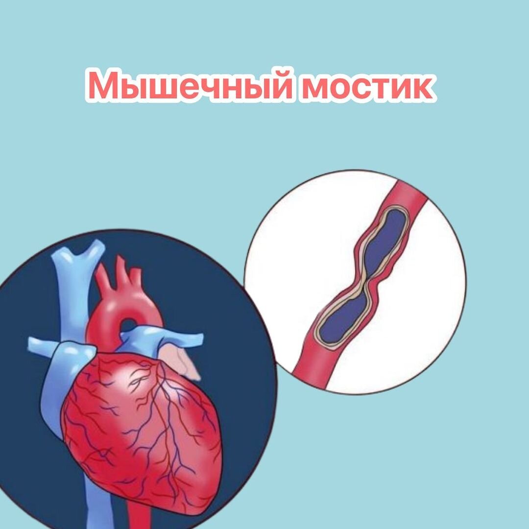 Миокардиальный мостик - это редкое, но потенциально серьезное состояние, когда часть артерии сердца (обычно левой коронарной артерии) проникает в миокард (мышечную ткань сердца) вместо того, чтобы...