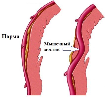 Миокардиальный мостик - это редкое, но потенциально серьезное состояние, когда часть артерии сердца (обычно левой коронарной артерии) проникает в миокард (мышечную ткань сердца) вместо того, чтобы...-2