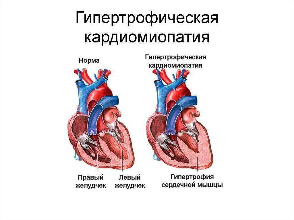 Увеличенное сердце у ребенка