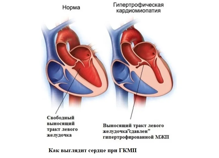 Кардиомиопатия предсердий. ЭХОКГ гипертрофия кардиомиопатия. Дилатационная кардиомиопатия на УЗИ сердца. Кардиомиопатия левого желудочка. Концентрическая кардиомиопатия.