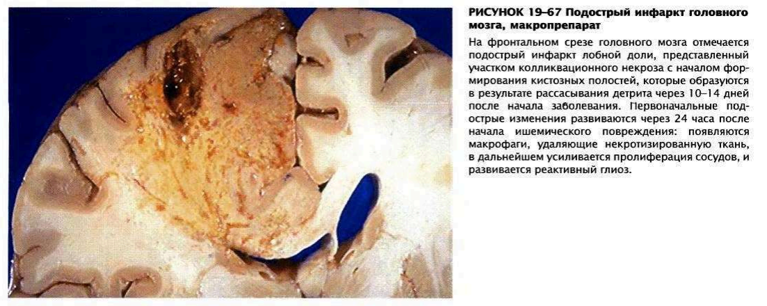 Иллюстрация из книги "Атлас патологии Роббинсон и Котран", Э.К, Клатт, 2010 г., 480 с.