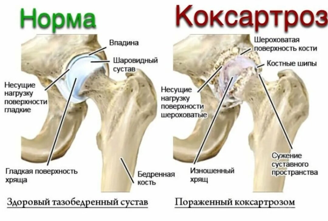 Колено впадина. Стерт хрящ тазобедренного сустава. Коксартроз тазобедренного сустава степени. Степени коксартроза тазобедренного сустава. Диспластический коксартроз тазобедренного сустава 3 степени.