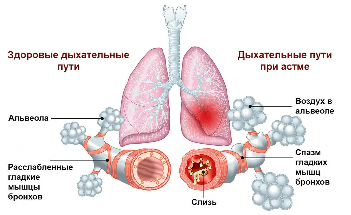 Механизм развития приступа бронхиальной астмы. Механизм развития бронхиальной астмы схема. Патогенез аллергической бронхиальной астмы. Патогенез бронхиальной астмы схема.