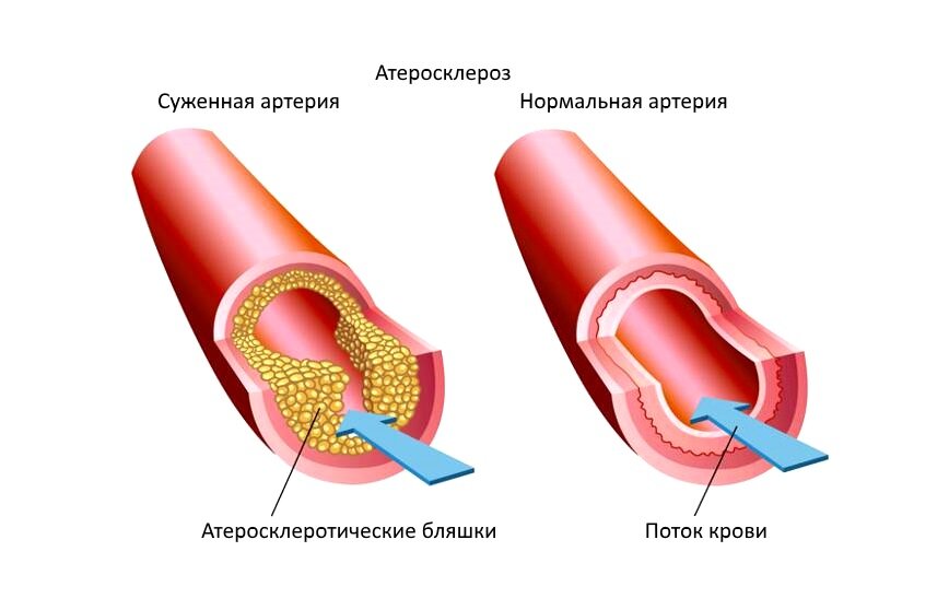 Атеросклероз 2 типа