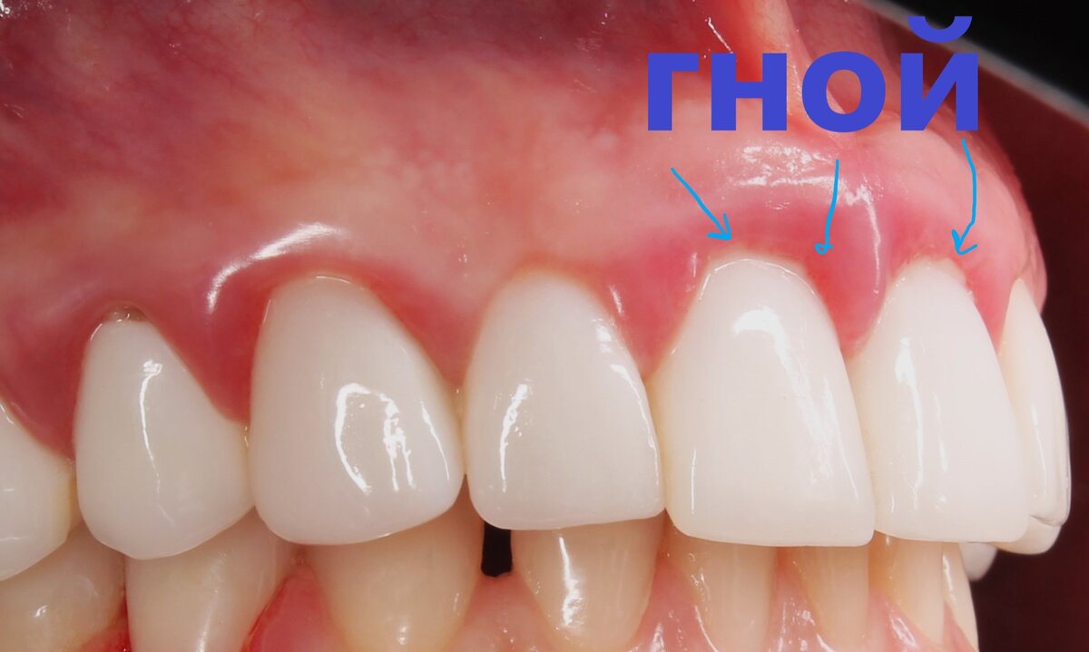 Гнойное отделяемое и виниры